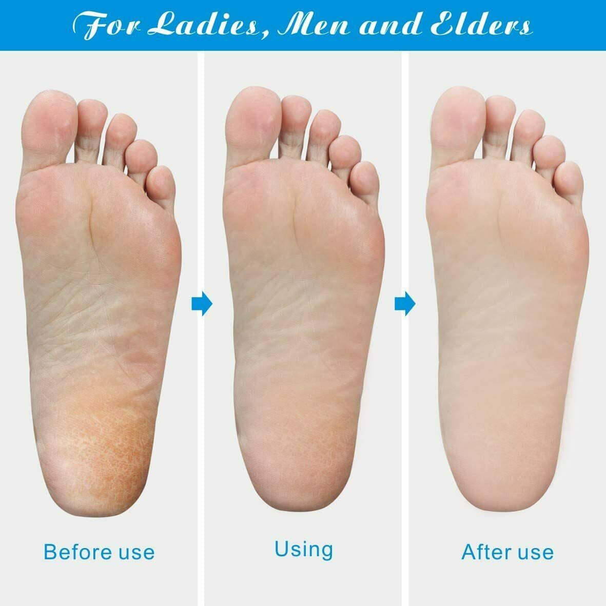 Professional Foot Callus Remover for Effortless Pedicures